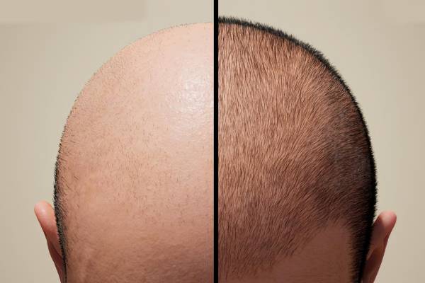 Best Hair Transplant Treatment in Pirangut, Mulshi - Mulshi Speciality Hospital