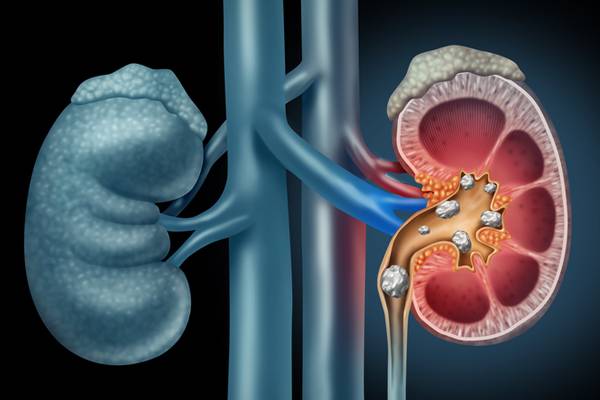 Kidney Stone Treatment In Pirangut, Mulshi - Mulshi Speciality Hospital